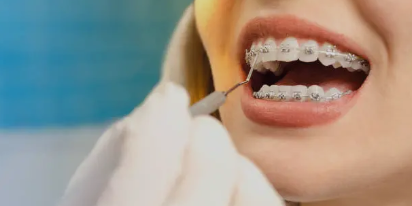 Bagues et Appareils Multi-attaches