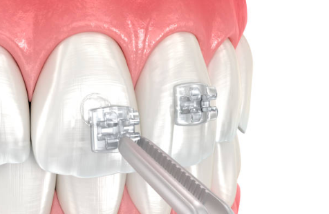 Les différentes techniques de traitement